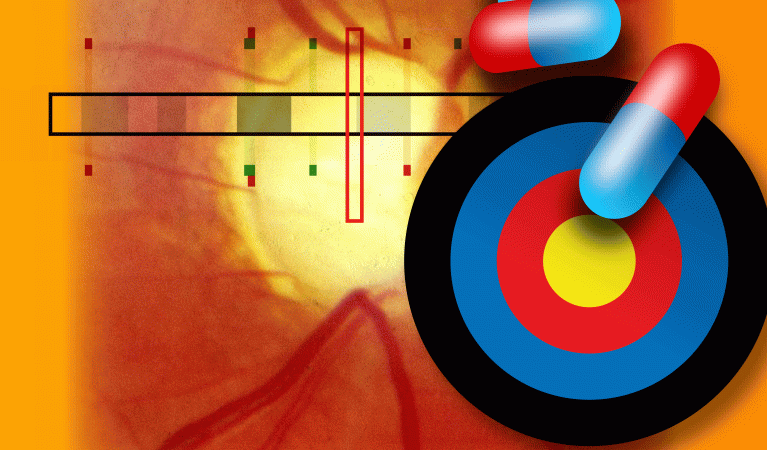 Identifieringen av en ny genvariant som skyddar mot glaukom öppnar upp nya möjligheter