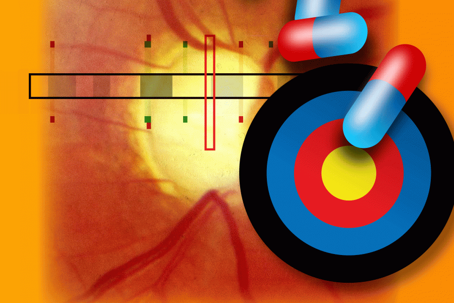 Identifieringen av en ny genvariant som skyddar mot glaukom öppnar upp nya möjligheter